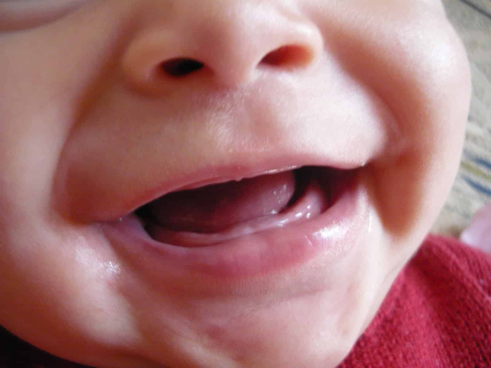 gengiva-bebe-inchada