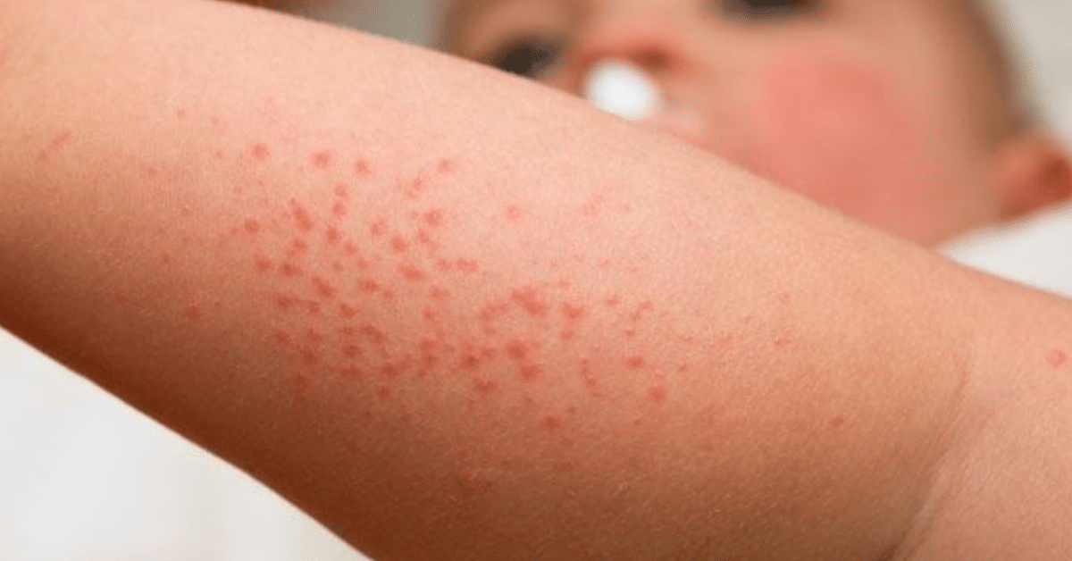 Dermatite atopica em criancas