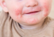dermatite atopica em criancas 1