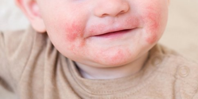 dermatite atopica em criancas 1