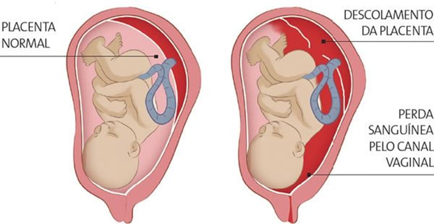 Descolamento da Placenta
