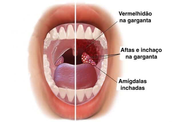 dor garganta bebe 2