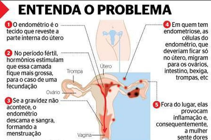 endometriose 1