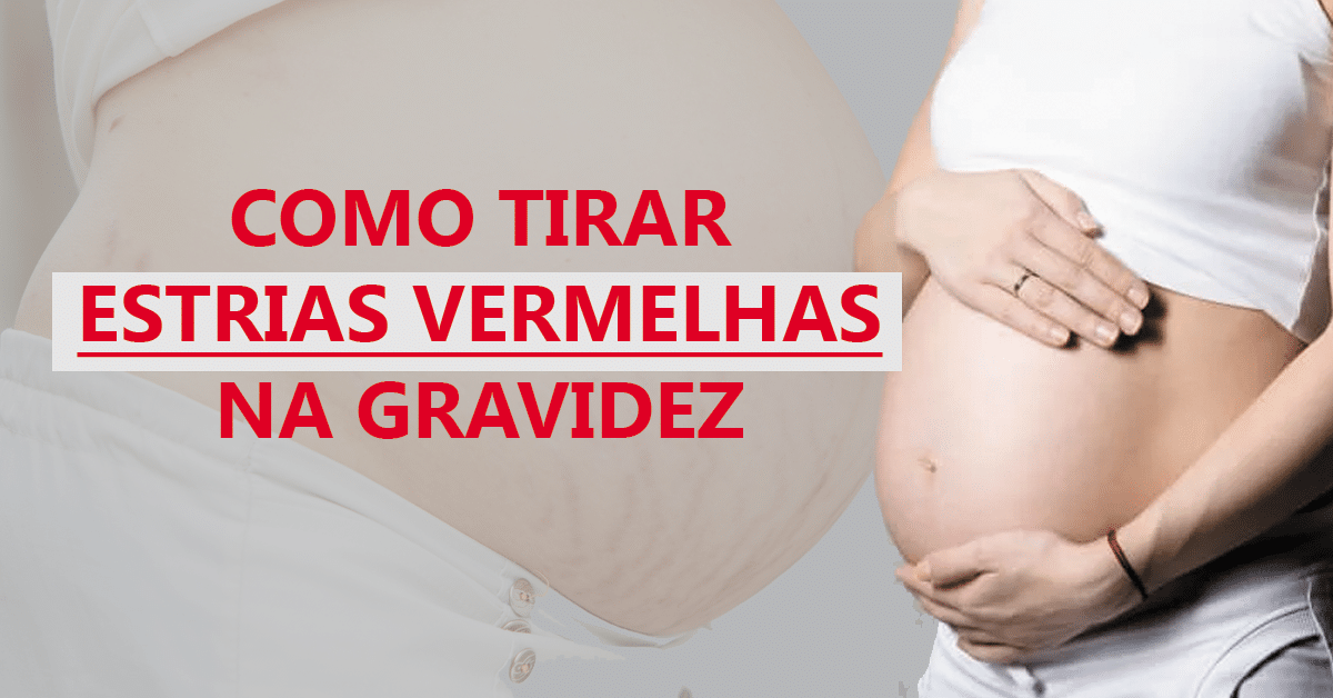 Estrias Vermelhas na Gravidez – Há Tratamento? Tem Cura?