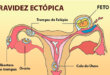 gravidez ectopica