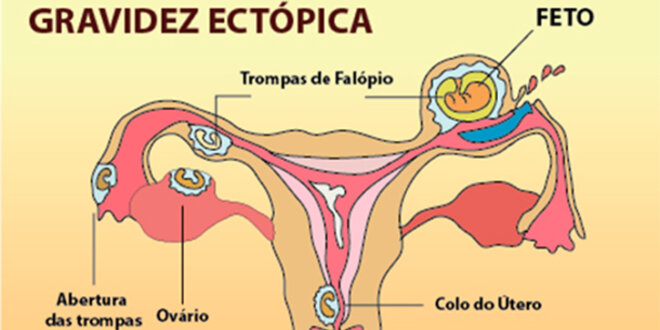 gravidez ectopica gravidez ectopica