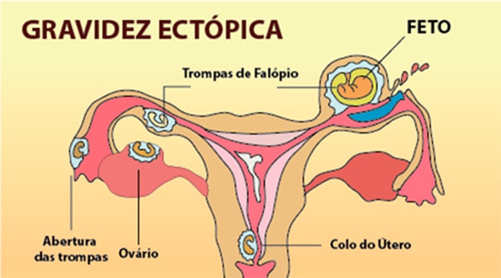 gravidez ectopica