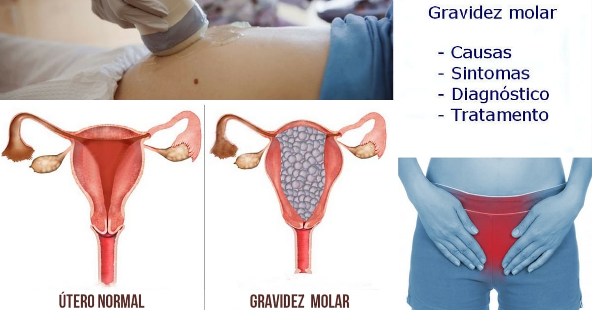 O Que é Gravidez Molar - NAZAEDU