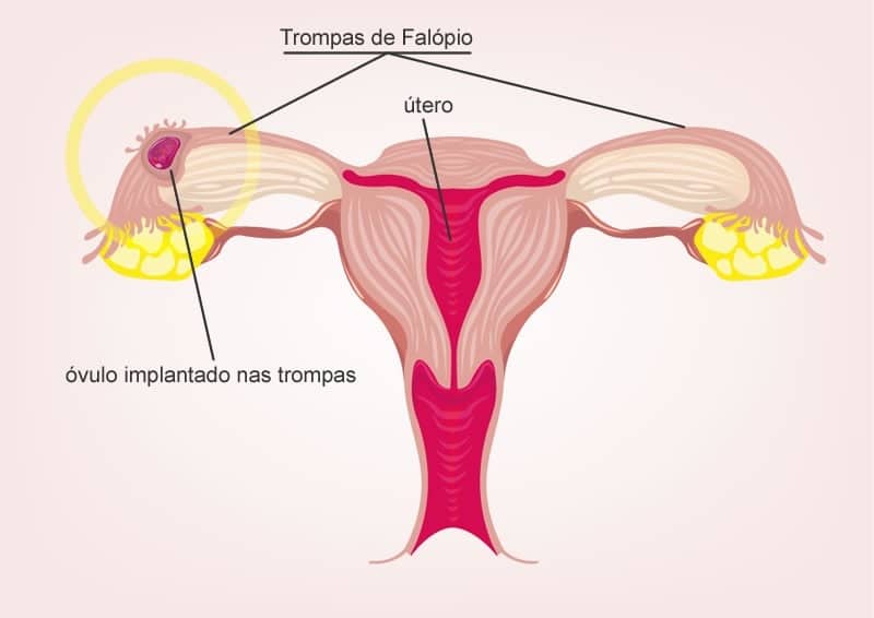 gravidez nas trompas