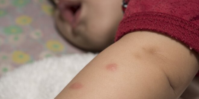 o que fazer bebe mordida mosquito o que fazer bebe mordida mosquito