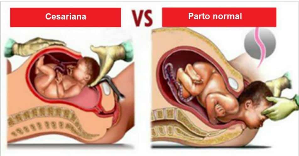 parto normal parto cesario