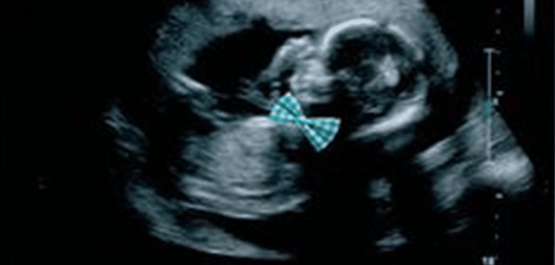 sinais gravidez menino
