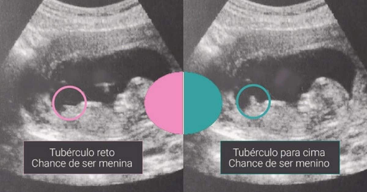 tuberculo genital fetal metodo